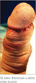 Fitymaszűkület (phimosis) - Tünetek, okok, kezelés, Phimosis műtét után erekció