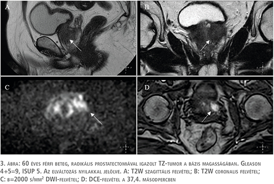 Multiparametrikus PROSZTATA kontrasztanyagos MR vizsgálat (mpMR) ​a RadiVert betegbarát Klinikán